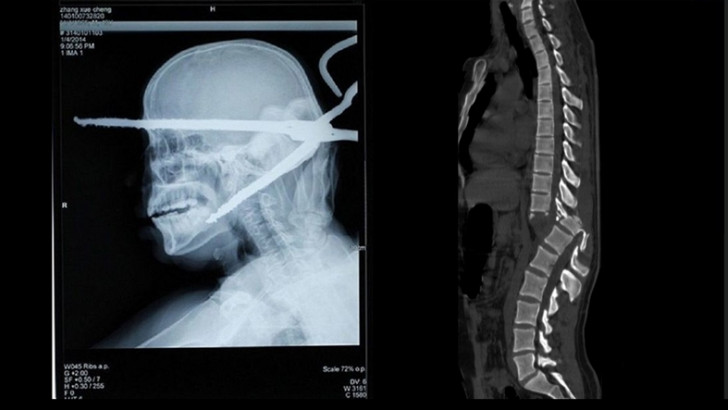 Hassas Bünyelerde Kalp Çarpıntısına Neden Olabilecek 22 X-ray Görüntüsü