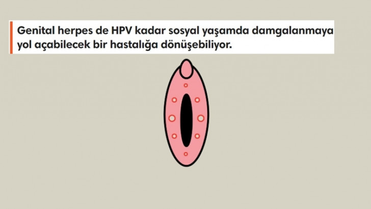 Cinsellikle Bulaşan ve Hayatınızı En Az HPV Kadar Olumsuz Etkileyen 'HSV Virüsü' Hakkında Bilmeniz Gerekenler