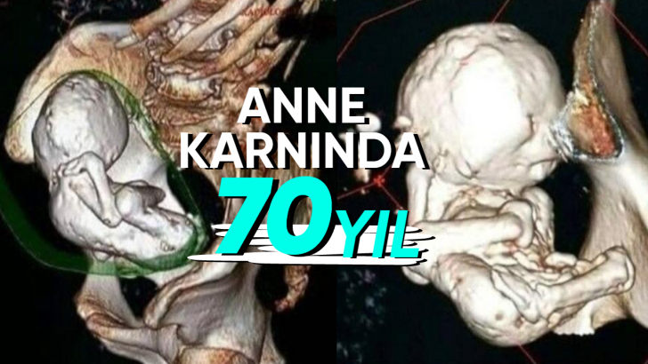 Anne Karnında Taşlaşmış Olan Gerçek Bir Bebeğe Bakıyorsunuz! Peki Bu Korkunç Vaka Nasıl Ortaya Çıkıyor?