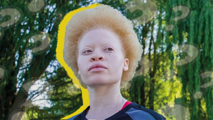 Saç ve Ciltte Renk Farklılığına Neden Olan Albino Hastalığı Nedir, Neden Olur, Kalıtsal mıdır?
