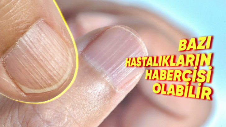 Tırnaktaki Bu Dikine Çıkıntılar Neden Olur? Önlemek İçin Neler Yapabilirsiniz?