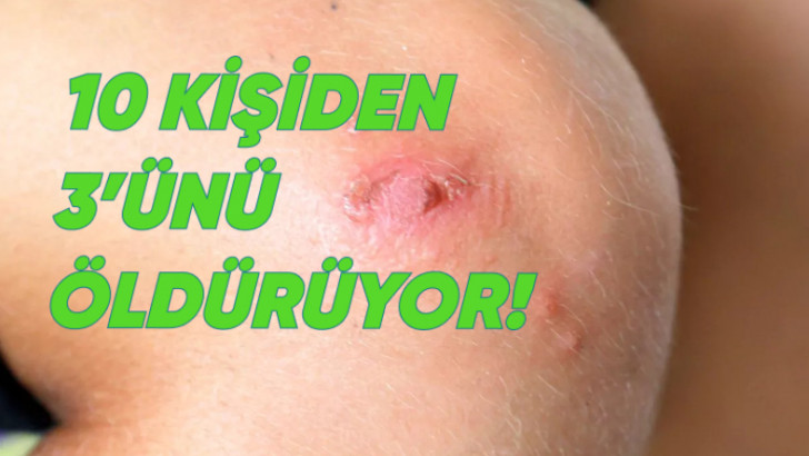 Japonya, Et yiyen Bakteri İstilâsı Altında: Ölüm Riski Çok Yüksek!