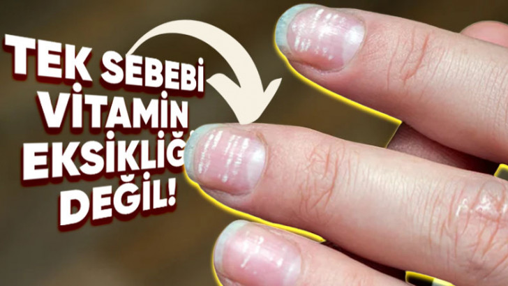 Tırnaklarımızda Oluşan Bu Beyaz Lekeler Ne Anlama Geliyor?