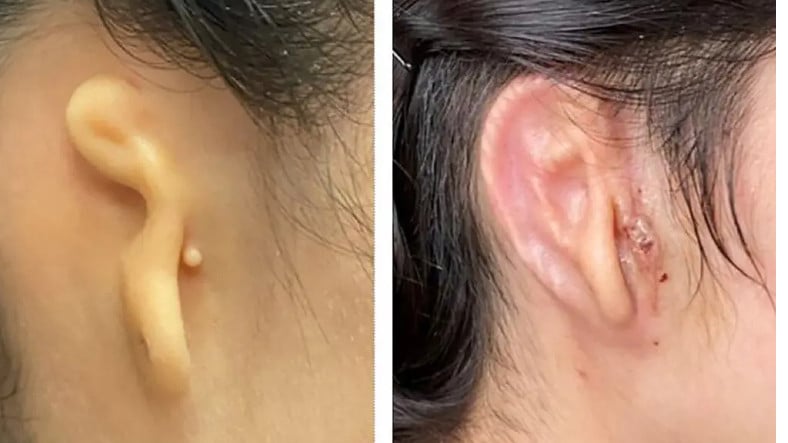 3D Yazıcıyla Elde Edilen Kulak, Bir İnsana Nakledildi: Tıp Dünyasında Bir Devrim Yaratabilir!