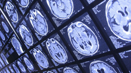 Yeni Bir Yöntem ile Parkinson Hastası Fareler 3 Ayda Tamamen Tedavi Edildi